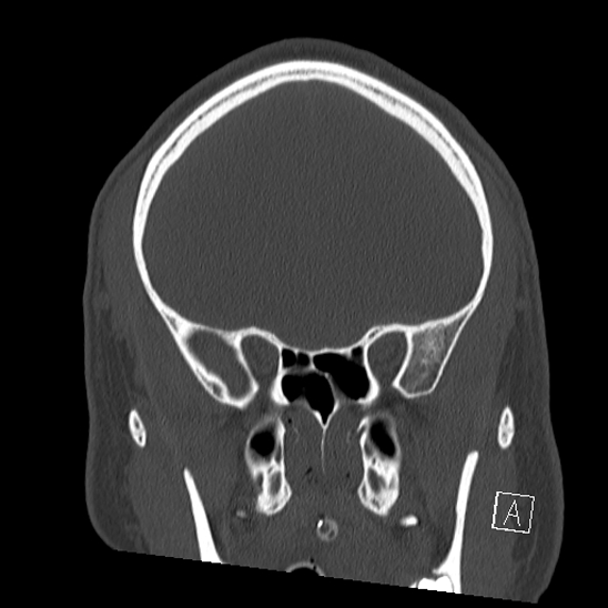 Bilateral occipital condyle fracture (type 2) (Radiopaedia 87675-104089 Coronal bone window 32).jpg