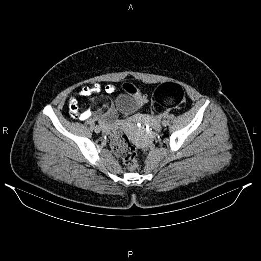 Bilateral ovarian dermoid cysts (Radiopaedia 85785-101603 Axial C+ delayed 68).jpg