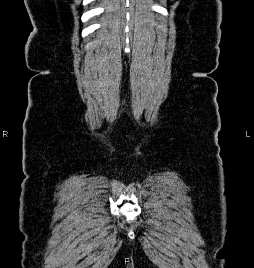 File:Bilateral ovarian dermoid cysts (Radiopaedia 85785-101603 C 60).jpg