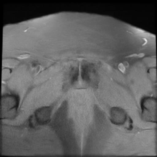 File:Bilateral ovarian dermoid cysts (Radiopaedia 90152-107338 Axial T1 fat sat 21).jpg