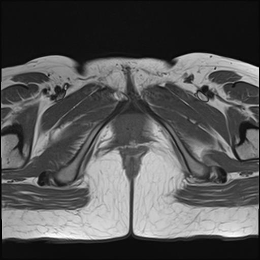 File:Bilateral ovarian endometriomas (Radiopaedia 87085-103347 Axial T1 23).jpg