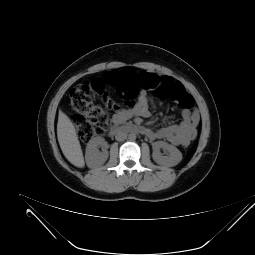 File:Bilateral ovarian mature cystic teratomas (Radiopaedia 79373-92457 Axial non-contrast 25).jpg