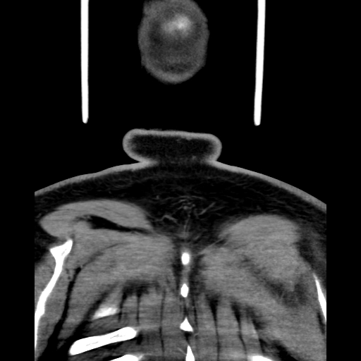Bilateral peritonsillar abscess (Radiopaedia 85065-100610 Coronal 73).jpg
