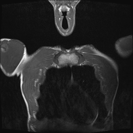 File:Bilateral spinoglenoid notch ganglion cysts (Radiopaedia 29577-30082 Coronal T1 1).jpg