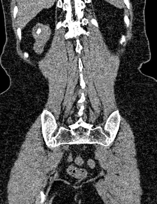Bilateral staghorn calculi (Radiopaedia 59475-66842 Coronal non-contrast 82).jpg