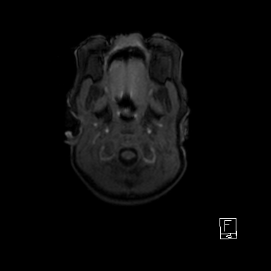 Bilateral subdural hemorrhage and parietal skull fracture (Radiopaedia 26058-26190 Axial T1 2).png