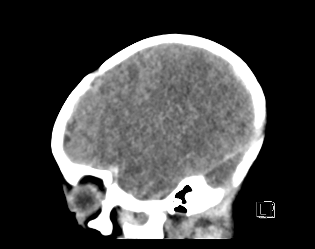 File:Bilateral subdural hemorrhage and parietal skull fracture (Radiopaedia 26058-26192 C 5).png