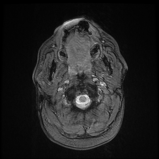File:Bilateral thalamic glioma (Radiopaedia 65729-74848 Axial Gradient Echo 1).jpg
