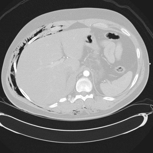 Bilateral traumatic renovascular injury (Radiopaedia 32051-32995 Axial lung window 49).jpg