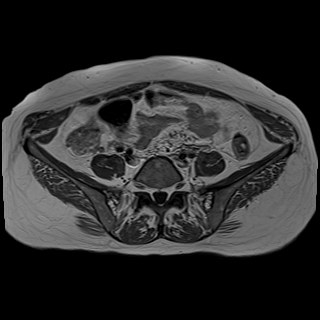 Bilateral tubo-ovarian abscesses (Radiopaedia 58635-65829 Axial T1 C+ 5).jpg
