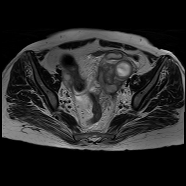 Bilateral tubo-ovarian abscesses (Radiopaedia 58635-65829 Axial T2 19).jpg