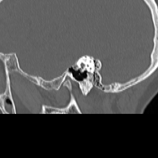 Bilateral tympanoplasty (Radiopaedia 16947-16664 Sagittal bone window 28).jpg