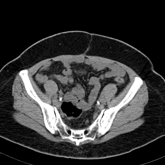 File:Bilateral ureteric stents (Radiopaedia 48795-53825 Axial non-contrast 50).jpg