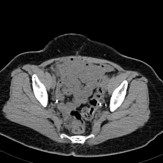 Bilateral ureteric stents (Radiopaedia 48795-53825 Axial non-contrast 57).jpg