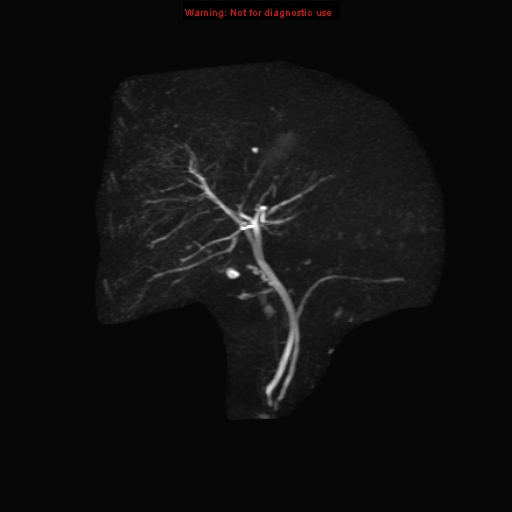 File:Biliary tree anatomical variant - biliary trifurcation (Radiopaedia 12531-12750 Coronal 3D MRCP 8).jpg
