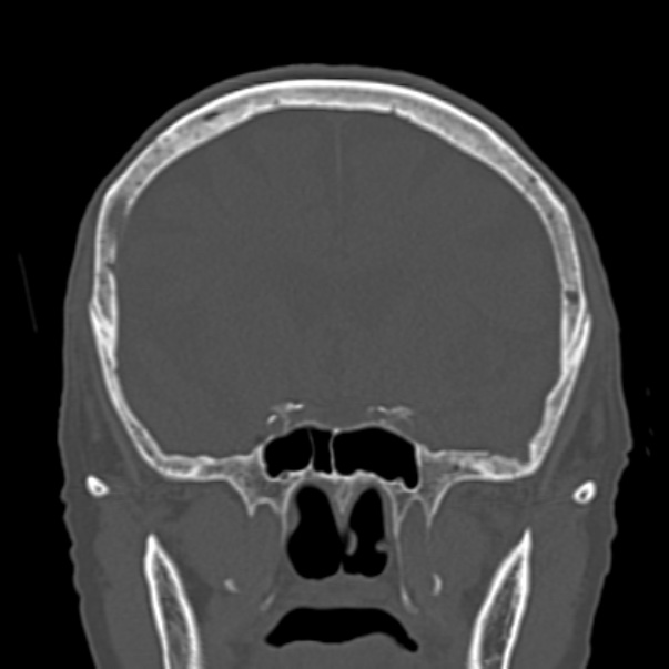 Biparietal osteodystrophy (Radiopaedia 46109-50463 Coronal bone window 44).jpg