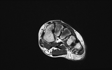 Bipartite hallux sesamoid diastasis (Radiopaedia 77133-89109 Coronal PD 4).jpg