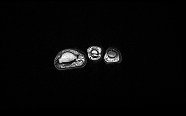 Bipartite hallux sesamoid diastasis (Radiopaedia 77133-89109 Coronal PD 50).jpg