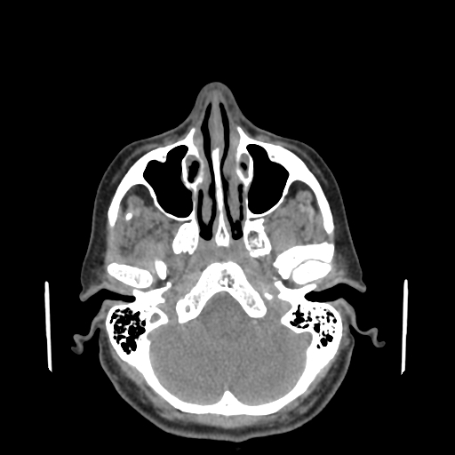 Bisphosphonate-related osteonecrosis of the jaw (Radiopaedia 71324-81642 non-contrast 149).jpg