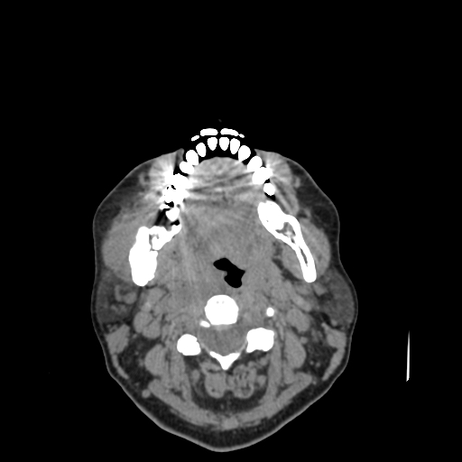 Bisphosphonate-related osteonecrosis of the jaw (Radiopaedia 71324-81642 non-contrast 69).jpg
