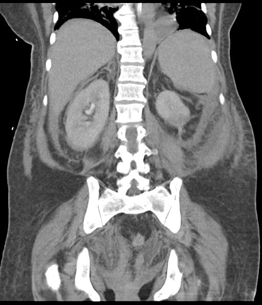 File:Bladder rupture post renal biopsy (Radiopaedia 30863-31572 Coronal non-contrast 42).jpg