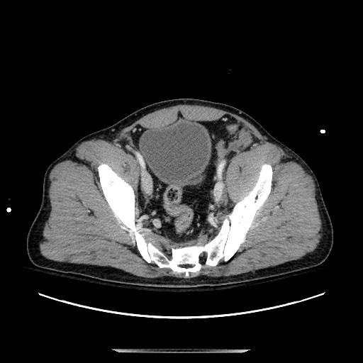 Blunt abdominal trauma with solid organ and musculoskelatal injury with active extravasation (Radiopaedia 68364-77895 A 131).jpg