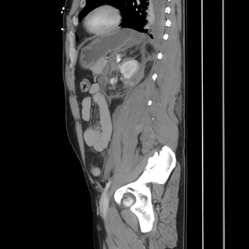 File:Blunt abdominal trauma with solid organ and musculoskelatal injury with active extravasation (Radiopaedia 68364-77895 C 99).jpg