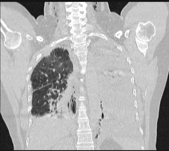 Boerhaave syndrome (Radiopaedia 45644-49799 Coronal lung window 47).jpg