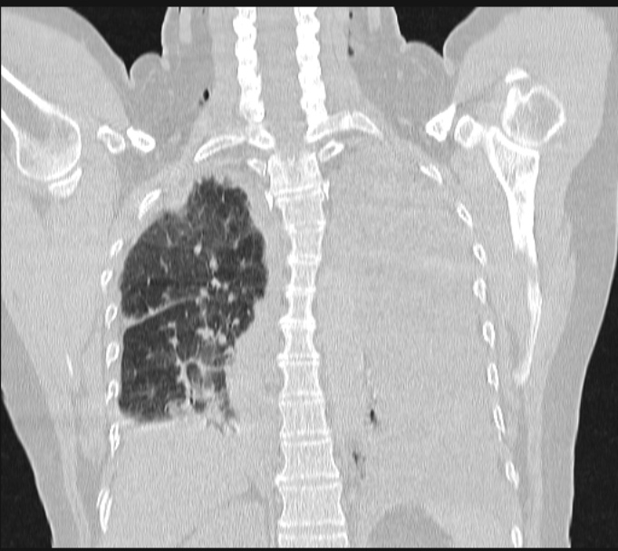 Boerhaave syndrome (Radiopaedia 45644-49799 Coronal lung window 49).jpg