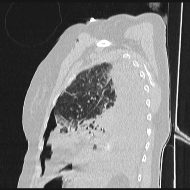 Boerhaave syndrome (Radiopaedia 45644-49799 Sagittal lung window 65).jpg