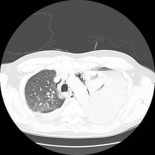 Boerhaave syndrome (Radiopaedia 59796-67310 Axial lung window 21).jpg