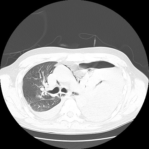 File:Boerhaave syndrome (Radiopaedia 59796-67310 Axial lung window 26).jpg