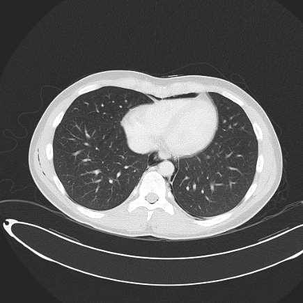 File:Boerhaave syndrome with mediastinal, axillary, neck and epidural free gas (Radiopaedia 41297-44115 Axial lung window 65).jpg