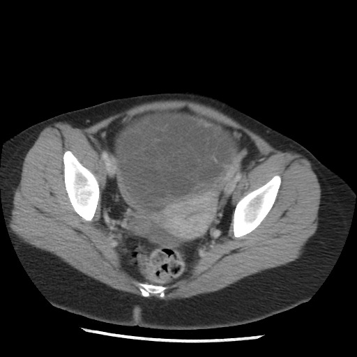 File:Borderline mucinous tumor (ovary) (Radiopaedia 78228-90808 A 127).jpg