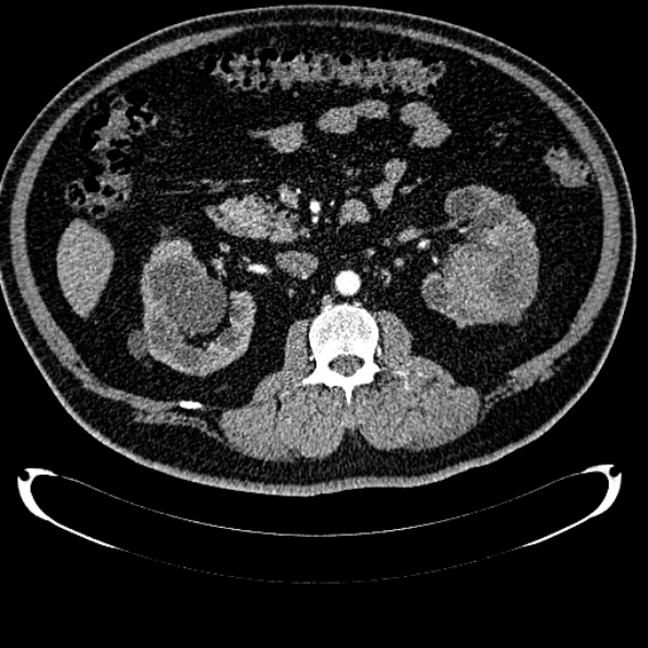 Bosniak renal cyst - type IV (Radiopaedia 24244-24518 B 149).jpg