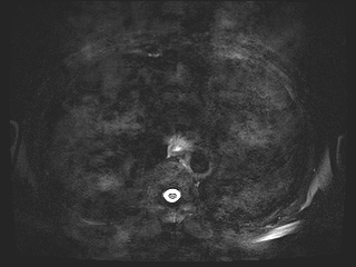 File:Bouveret syndrome (Radiopaedia 61017-68856 Axial MRCP 4).jpg