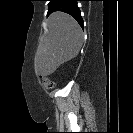 Bowel and splenic infarcts in acute lymphocytic leukemia (Radiopaedia 61055-68913 C 61).jpg