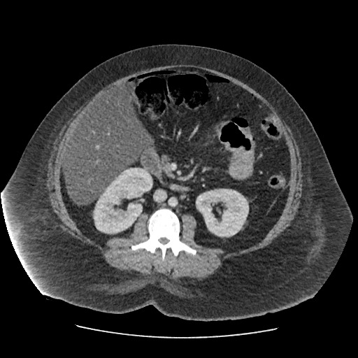 File:Bowel and splenic infarcts in acute lymphocytic leukemia (Radiopaedia 61055-68915 A 66).jpg