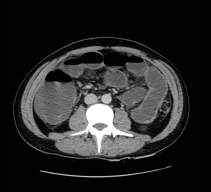 Bowel obstruction from colon carcinoma (Radiopaedia 22995-23028 A 44).jpg