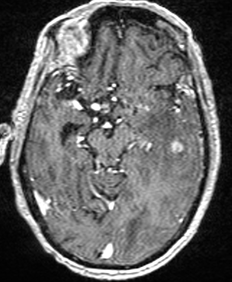 Brain abscess with dual rim sign (Radiopaedia 87566-103938 Axial T1 C+ 70).jpg