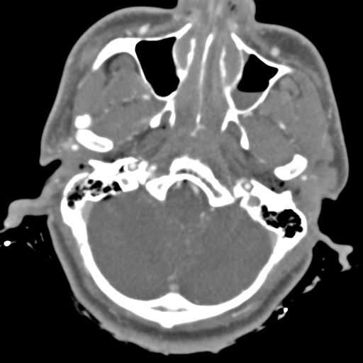 File:Brain contusions, internal carotid artery dissection and base of skull fracture (Radiopaedia 34089-35339 D 45).png