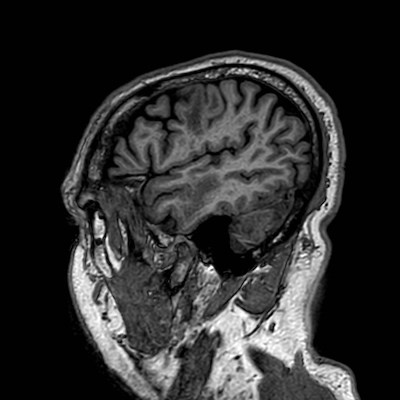 Brain metastases from lung cancer (Radiopaedia 83839-99028 Sagittal T1 109).jpg
