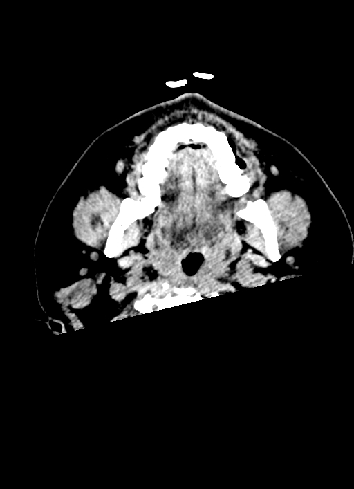 Brainstem hemorrhage (Radiopaedia 81294-94976 Axial non-contrast 76).jpg