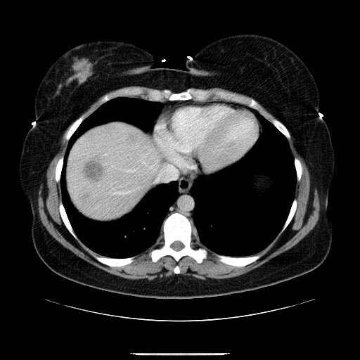 Breast cancer pseudocirrhosis after chemotherapy (Radiopaedia 65407-74456 A 11).jpg