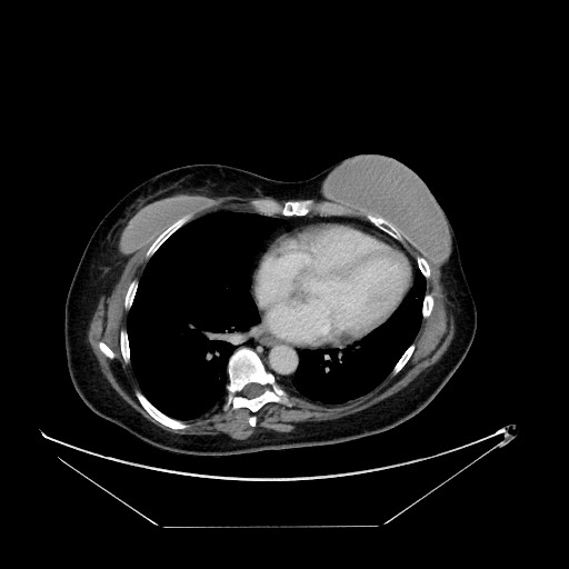File:Breast cancer pseudocirrhosis with lobar invovlement (Radiopaedia 81080-94670 A 7).jpg