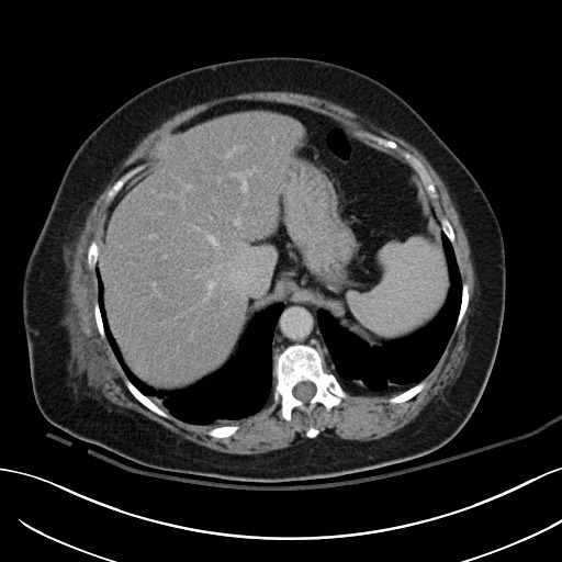 Breast carcinoma with pathological hip fracture (Radiopaedia 60314-67974 B 13).jpg