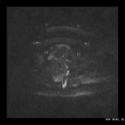 File:Broad ligament fibroid (Radiopaedia 49135-54241 Axial DWI 22).jpg