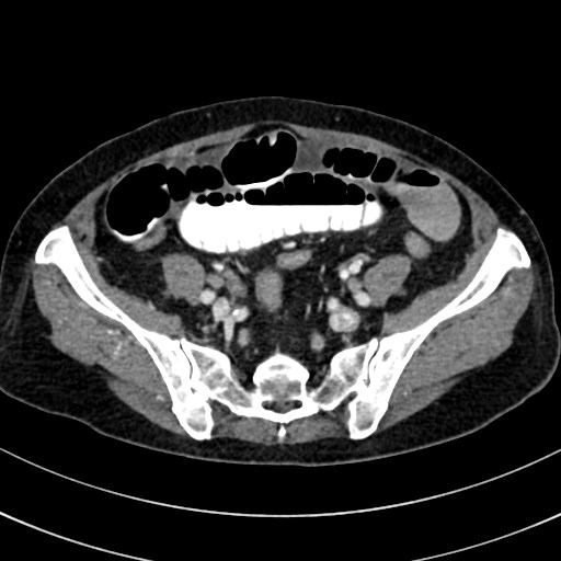 File:Broad ligament hernia (Radiopaedia 84802-100276 A 58).jpg
