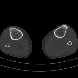 Brodie abscess - tibia (Radiopaedia 66028-75204 Axial bone window 18).jpg