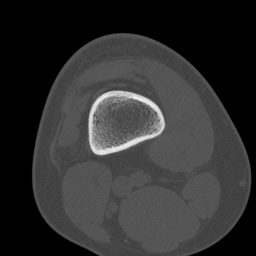 Brodie abscess of the tibia (Radiopaedia 58984-66250 Axial bone window 3).jpg
